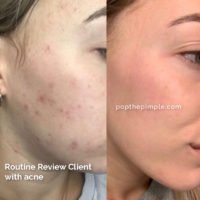 acne-prone skin before and after, popthepimple, best acne blog, acne healing results
