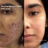 acne-prone skin before and after, popthepimple, best acne blog, acne healing results