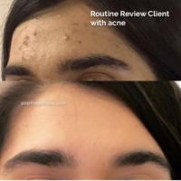 acne-prone skin before and after, popthepimple, best acne blog, acne healing results
