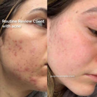 acne-prone skin before and after, popthepimple, best acne blog, acne healing results