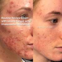 acne-prone skin before and after, popthepimple, best acne blog, acne healing results, malassezia folliculitis healing