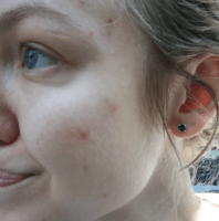 acne, adult acne, pimple popping