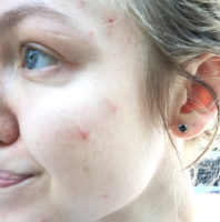 acne, adult acne, pimple popping