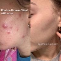 acne rosacea, before and after, how to get rid of acne, olena beley skin coach, skin health, acne coaching, custom routine, routine review results