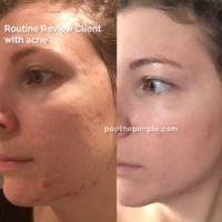 acne rosacea, before and after, how to get rid of acne, olena beley skin coach, skin health, acne coaching, custom routine, routine review results