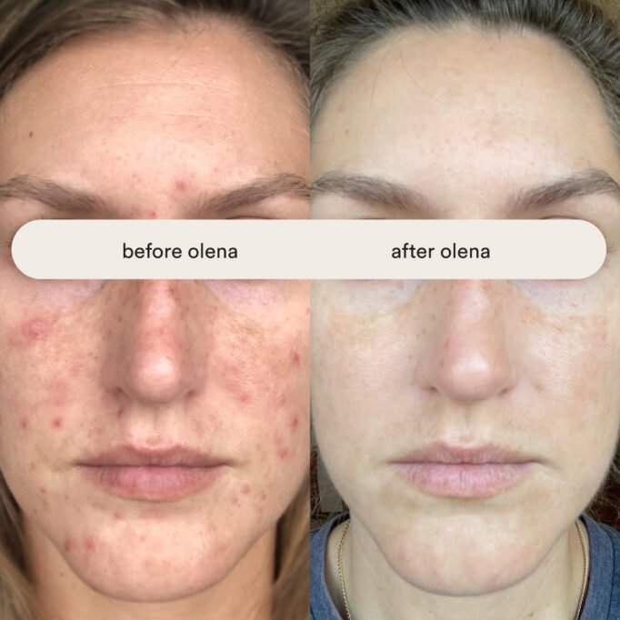 how-to-get-clear-skin-acne-before-and-after