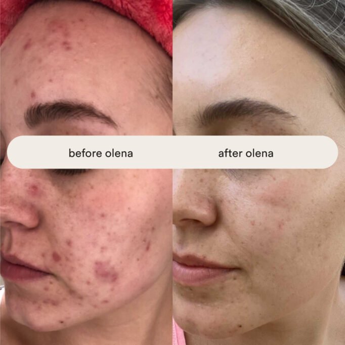 how-to-get-clear-skin-with-skincare-healing-ance