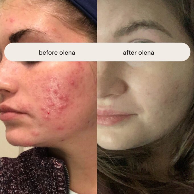 how-to-get-clear-skin-without-diets,-pills,-or-fancy-treatments