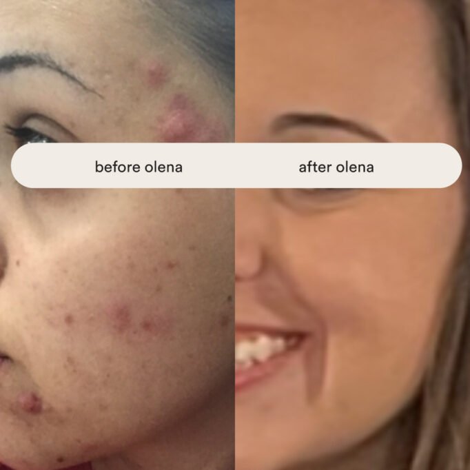how-to-get-rid-of-acne-for-good-olena-beley-skincare-coach