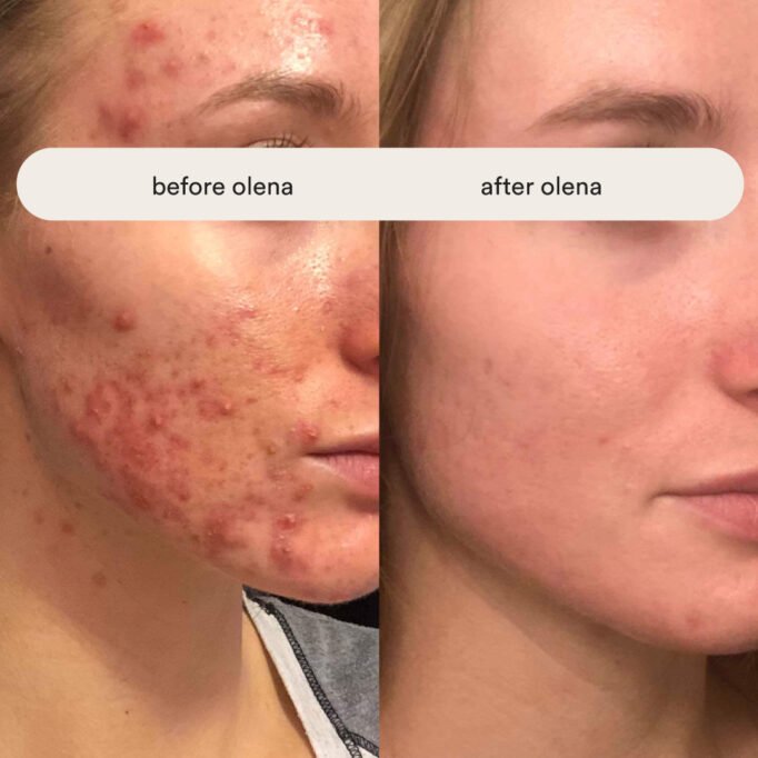 how-to-get-rid-of-acne-olena-beley-client-results-routine-review-malassezia