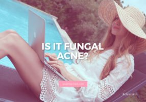 treating fungal acne, how to treat fungal acne, yeast overgrowth, Pityrosporum (Malassezia) Folliculitis, itchy acne