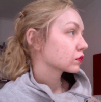olena, pop the pimple, acne help, how to get clear skin, best acne blog 2017
