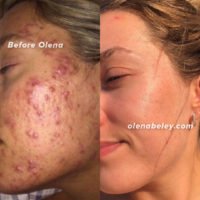 olena beley acne coach, acne healing, acne before and after