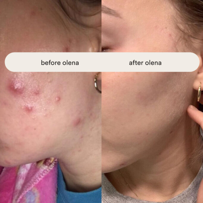 olena-beley-routine-review-service-results,-how-to-get-rid-of-acne-successfully