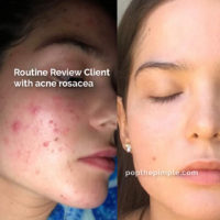 acne rosacea, before and after, how to get rid of acne, olena beley skin coach, skin health, acne coaching, custom routine, routine review results