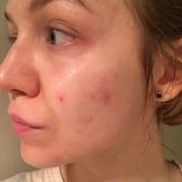 pop the pimple, adult acne, argan oil, acne-prone skin, pimples