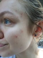 oils acne, skin oil, jojoba oil, acne, how to cure acne, should I use oils on my skin, can oils heal acne
