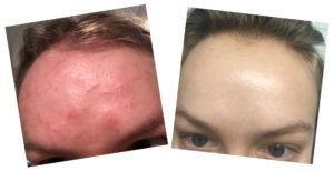 olena, pop the pimple, acne help, how to get clear skin, best acne blog 2017
