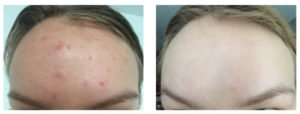 olena, pop the pimple, acne help, how to get clear skin, best acne blog 2017