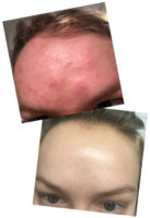 olena, pop the pimple, acne help, how to get clear skin, best acne blog 2017