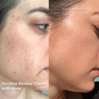 acne-prone skin before and after, popthepimple, best acne blog, how to get rid of acne, olena beley acne coach