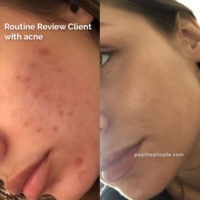 acne-prone skin before and after, popthepimple, best acne blog