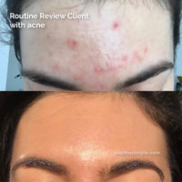 acne-prone skin before and after, popthepimple, best acne blog, skincare advice for acne