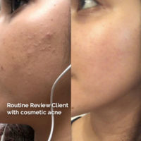 acne-prone skin before and after, popthepimple, best acne blog, cosmetic acne, comedonal acned