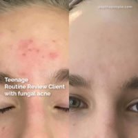 malassezia folliculitis, teenage acne, how to get rid of acne in teenagers