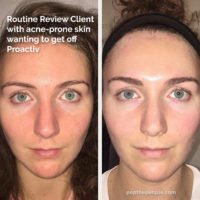 acne-prone skin before and after, popthepimple, best acne blog