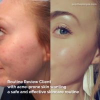 acne-prone skin before and after, popthepimple, best acne blog