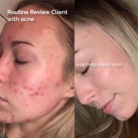 acne rosacea, before and after, how to get rid of acne, olena beley skin coach, skin health, acne coaching, custom routine, routine review results