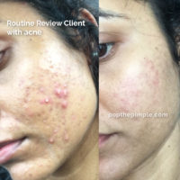 inflammatory acne, before and after, how to get rid of acne, olena beley skin coach, skin health, acne coaching, custom routine, routine review results