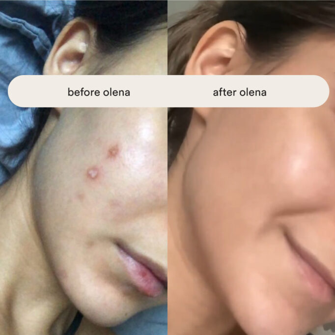 skin-queen-course-before-and-after-healing-acne-with-skincare-only